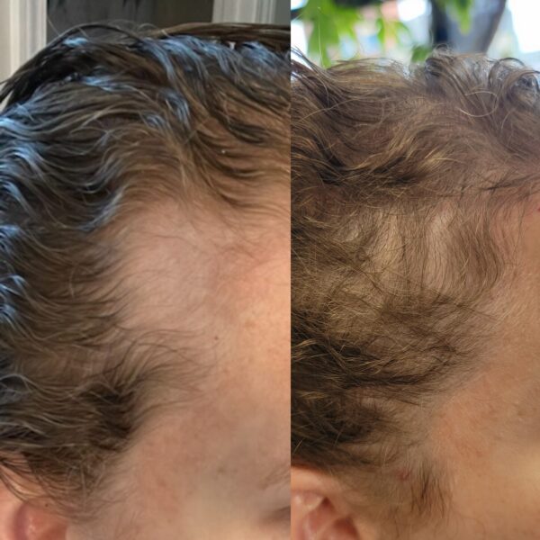 Hair loss before and after treatment.