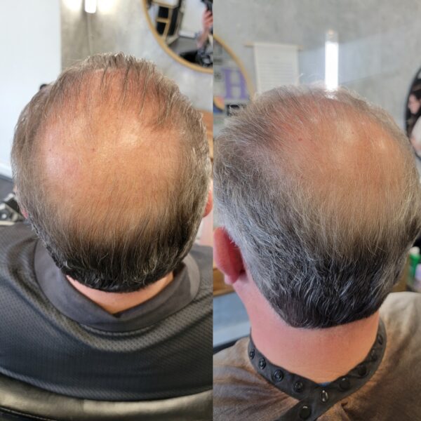 Hair loss treatment before and after.