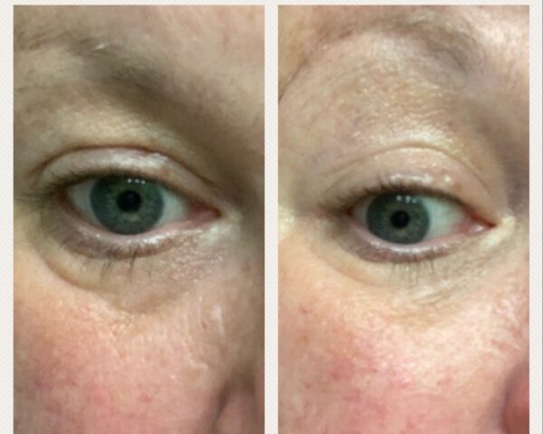 Before and after eye treatment.