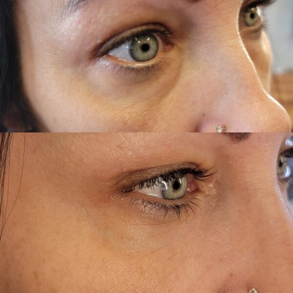 Close-up of eye before and after treatment.